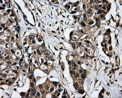 IHC of paraffin-embedded Adenocarcinoma of breast tissue using anti-DCXR mouse monoclonal antibody. (Dilution 1:50).