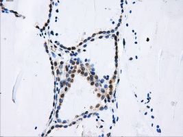 IHC of paraffin-embedded thyroid tissue using anti-DCXR mouse monoclonal antibody. (Dilution 1:50).