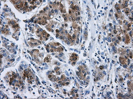 IHC of paraffin-embedded Carcinoma of liver tissue using anti-DCXR mouse monoclonal antibody. (Dilution 1:50).