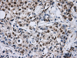 IHC of paraffin-embedded Adenocarcinoma of breast tissue using anti-DCXR mouse monoclonal antibody. (Dilution 1:50).