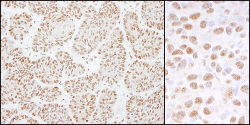Detection of Human and Mouse DDB1 by Immunohistochemistry. Sample: FFPE section of human pancreatic islet cell tumor (left) and mouse squamous cell carcinoma (right). Antibody: Affinity purified rabbit anti-DDB1 used at a dilution of 1:1000 (0.2 ug/ml). Detection: DAB.