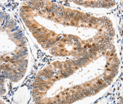 Immunohistochemistry of paraffin-embedded human cervical cancer tissue using DDB1 antibody.