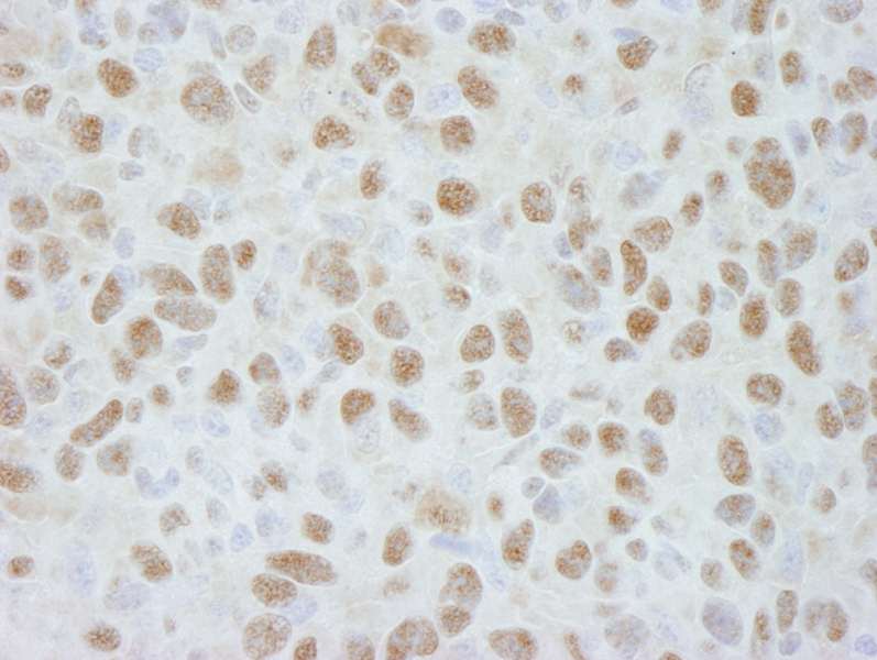 Detection of Mouse DDB1 by Immunohistochemistry. Sample: FFPE section of mouse squamous cell carcinoma tumor. Antibody: Affinity purified rabbit anti-DDB1 used at a dilution of 1:250.