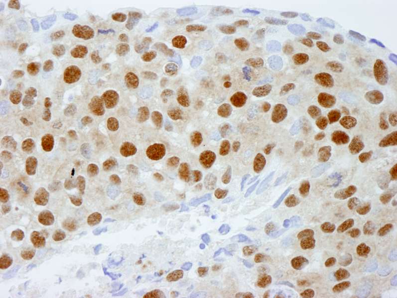 Detection of Human DDB1 by Immunohistochemistry. Sample: FFPE section of human breast tumor. Antibody: Affinity purified rabbit anti-DDB1 used at a dilution of 1:250.