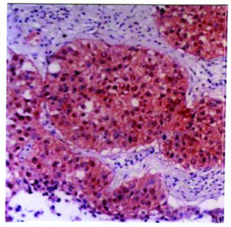 Left: Immunoperoxidase staining of formalin-fixed paraffin embedded human lung cancer tissue showing cytoplasmic localization of dihydrodiol dehydrogenase. Right: Western blot of DDH antibody (LS-C26685) on porcine liver (A) and breast cancer (B).