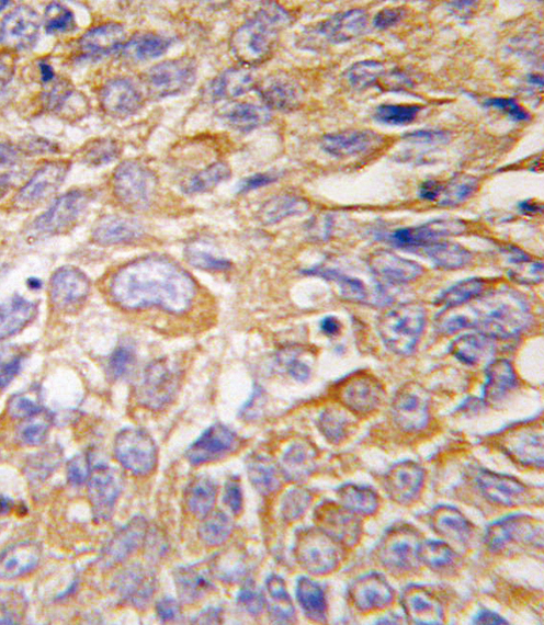 Formalin-fixed and paraffin-embedded human lung carcinoma tissue reacted with DDIT4 antibody , which was peroxidase-conjugated to the secondary antibody, followed by DAB staining. This data demonstrates the use of this antibody for immunohistochemistry; clinical relevance has not been evaluated.