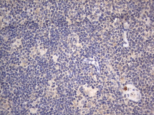 IHC of paraffin-embedded Human lymphoma tissue using anti-DDOST mouse monoclonal antibody. (Heat-induced epitope retrieval by 1 mM EDTA in 10mM Tris, pH8.5, 120°C for 3min).