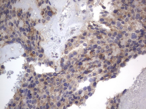 IHC of paraffin-embedded Adenocarcinoma of Human breast tissue using anti-DDOST mouse monoclonal antibody. (Heat-induced epitope retrieval by 1 mM EDTA in 10mM Tris, pH8.5, 120°C for 3min).