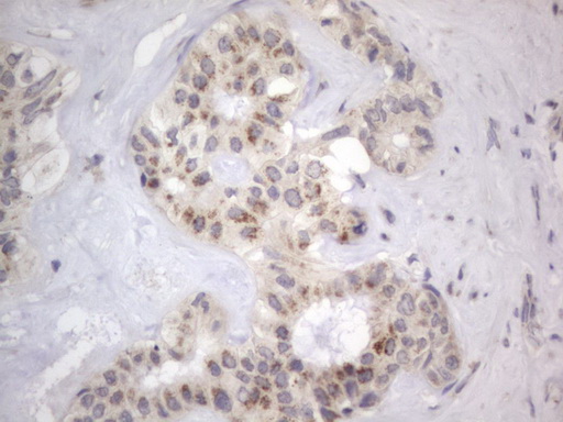 IHC of paraffin-embedded Carcinoma of Human liver tissue using anti-DDOST mouse monoclonal antibody. (Heat-induced epitope retrieval by 1 mM EDTA in 10mM Tris, pH8.5, 120°C for 3min).