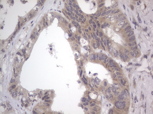 IHC of paraffin-embedded Adenocarcinoma of Human colon tissue using anti-DDOST mouse monoclonal antibody. (Heat-induced epitope retrieval by 1 mM EDTA in 10mM Tris, pH8.5, 120°C for 3min).