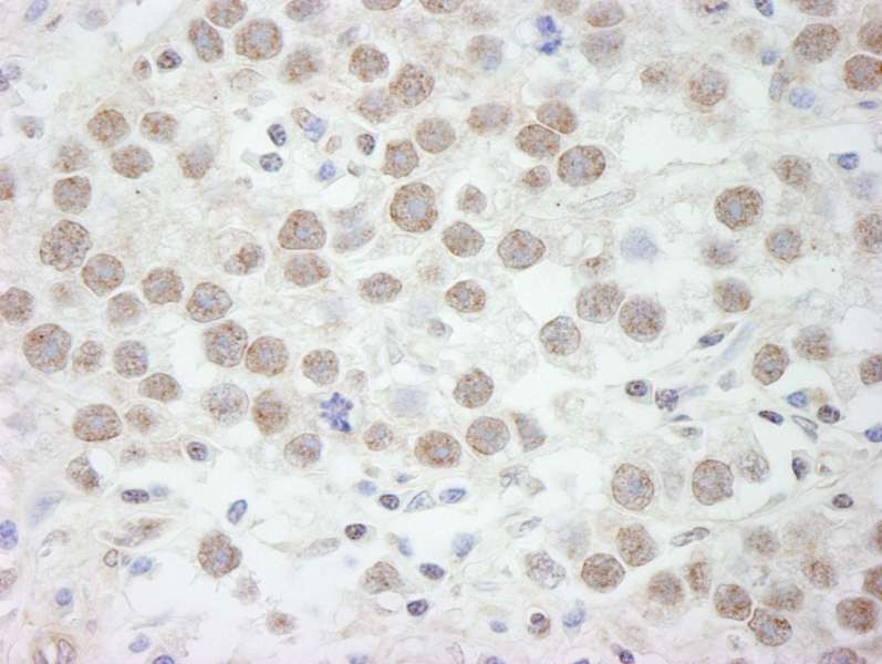 Detection of Human DDX17 by Immunohistochemistry. Sample: FFPE section of human seminoma. Antibody: Affinity purified rabbit anti-DDX17 used at a dilution of 1:500.