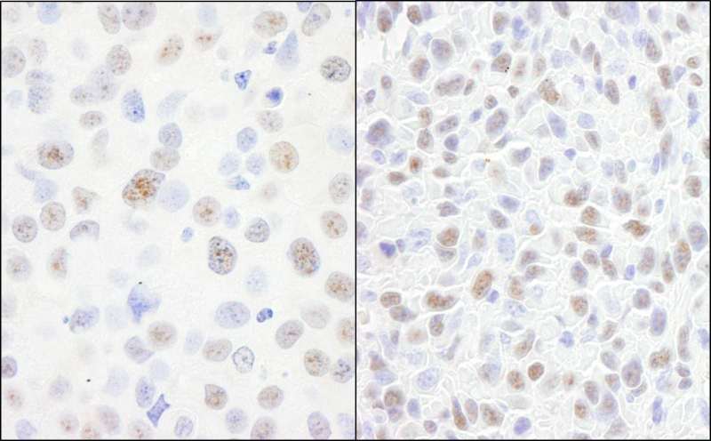 Detection of Human and Mouse DDX21 by Immunohistochemistry. Sample: FFPE section of human breast carcinoma (left) and mouse squamous cell carcinoma (right). Antibody: Affinity purified rabbit anti-DDX21 used at a dilution of 1:200 (1 ug/ml). Detection: DAB.