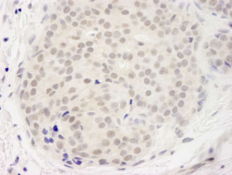 Detection of Human DDX23 by Immunohistochemistry. Sample: FFPE section of human breast carcinoma. Antibody: Affinity purified rabbit anti-DDX23 used at a dilution of 1:250. Epitope Retrieval Buffer-High pH (IHC-101J) was substituted for Epitope Retrieval Buffer-Reduced pH.