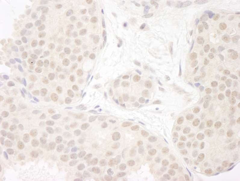 Detection of Human DDX23 by Immunohistochemistry. Sample: FFPE section of human breast carcinoma. Antibody: Affinity purified rabbit anti-DDX23 used at a dilution of 1:200 (1 ug/ml). Detection: DAB.