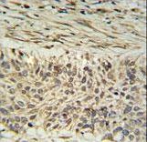 DDX23 Antibody IHC of formalin-fixed and paraffin-embedded lung carcinoma followed by peroxidase-conjugated secondary antibody and DAB staining.