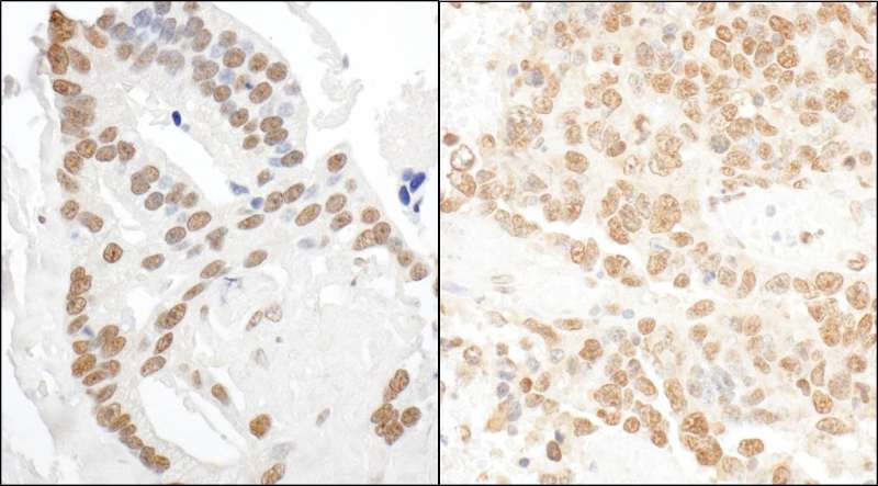 Detection of Human and Mouse DDX27 by Immunohistochemistry. Sample: FFPE section of human prostate carcinoma (left) and mouse teratoma (right). Antibody: Affinity purified rabbit anti-DDX27 used at a dilution of 1:5000 (0.2 ug/ml) and 1:1000 (1 ug/ml). Detection: DAB.