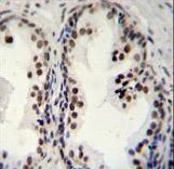 DDX27 Antibody immunohistochemistry of formalin-fixed and paraffin-embedded human prostate carcinoma followed by peroxidase-conjugated secondary antibody and DAB staining.