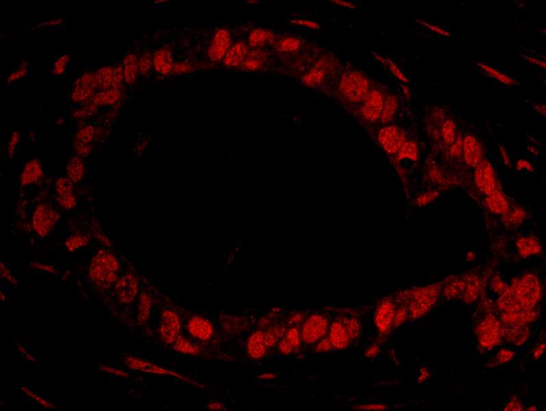 Detection of Human DDX27 by Immunohistochemistry. Sample: FFPE section of human ovarian carcinoma. Antibody: Affinity purified rabbit anti-DDX27 used at a dilution of 1:100. Detection: Red-fluorescent Goat anti-Rabbit IgG-heavy and light chain cross-adsorbed Antibody DyLight 594 Conjugated (A120-601D4) used at a dilution of 1:100.