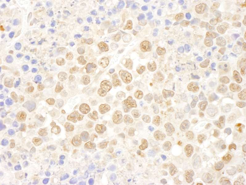 Detection of Mouse DDX27 by Immunohistochemistry. Sample: FFPE section of mouse hybridoma tumor. Antibody: Affinity purified rabbit anti-DDX27 used at a dilution of 1:100.