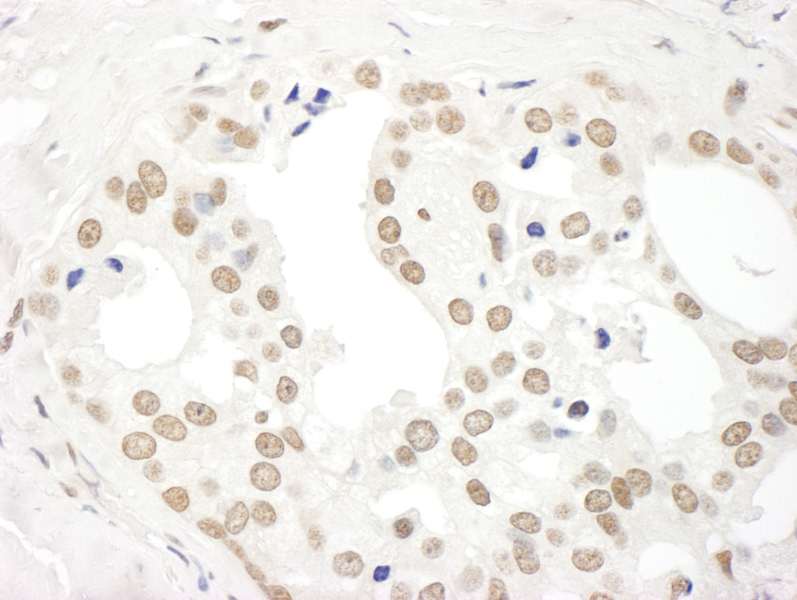 Detection of Human DDX27 by Immunohistochemistry. Sample: FFPE section of human prostate carcinoma. Antibody: Affinity purified rabbit anti-DDX27 used at a dilution of 1:500.