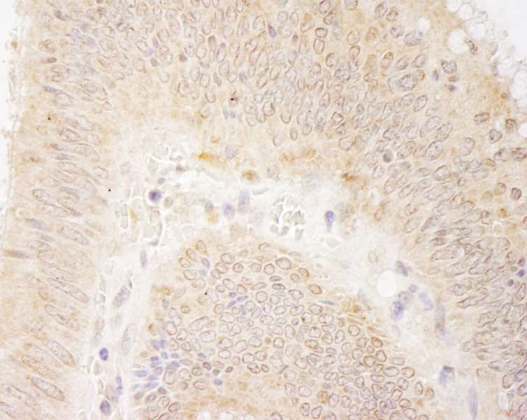 Detection of Human DDX28 by Immunohistochemistry. Sample: FFPE section of human colon carcinoma. Antibody: Affinity purified rabbit anti-DDX28 used at a dilution of 1:500 (2 ug/ml). Detection: DAB.