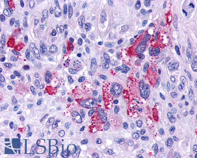Anti-GPR162 antibody IHC of human Brain, Glioblastoma. Immunohistochemistry of formalin-fixed, paraffin-embedded tissue after heat-induced antigen retrieval.