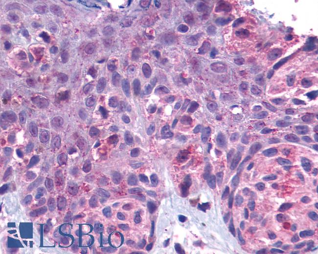 Anti-GPR162 antibody IHC of human Skin, Melanoma. Immunohistochemistry of formalin-fixed, paraffin-embedded tissue after heat-induced antigen retrieval.