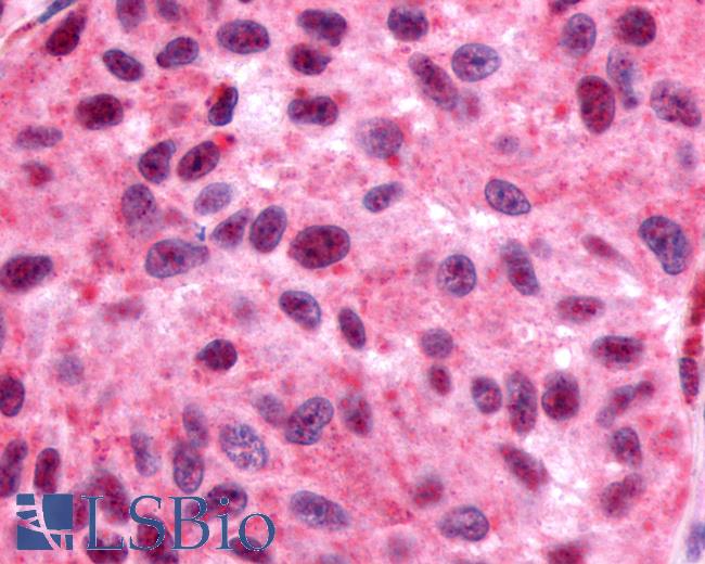 Anti-GPR162 antibody IHC of human Skin, Melanoma. Immunohistochemistry of formalin-fixed, paraffin-embedded tissue after heat-induced antigen retrieval.