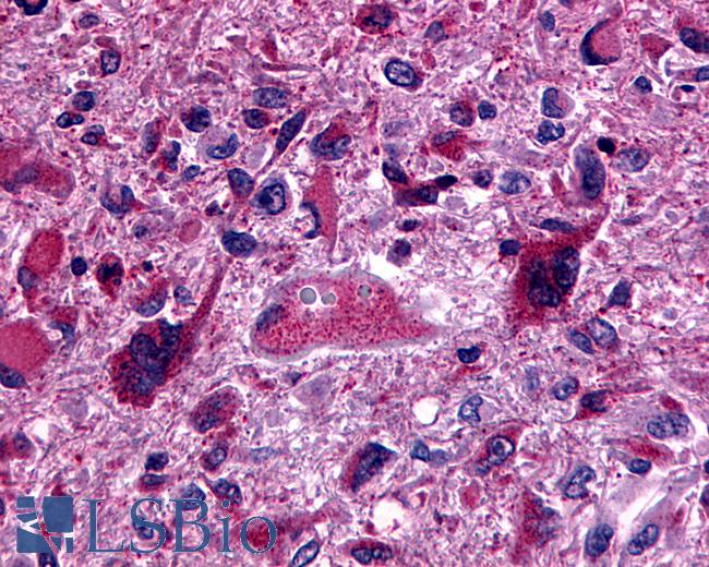 Anti-GPR162 antibody IHC of human Brain, Glioblastoma. Immunohistochemistry of formalin-fixed, paraffin-embedded tissue after heat-induced antigen retrieval.