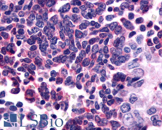 Anti-GPR162 antibody IHC of human Lung, Small Cell Carcinoma. Immunohistochemistry of formalin-fixed, paraffin-embedded tissue after heat-induced antigen retrieval.