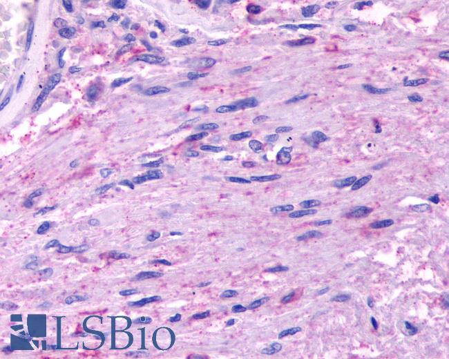 Anti-HTR5A / 5-HT5A Receptor antibody IHC of human Brain, Glioblastoma. Immunohistochemistry of formalin-fixed, paraffin-embedded tissue after heat-induced antigen retrieval.