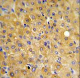 DLG7 Antibody IHC of formalin-fixed and paraffin-embedded hepatocarcinoma followed by peroxidase-conjugated secondary antibody and DAB staining.