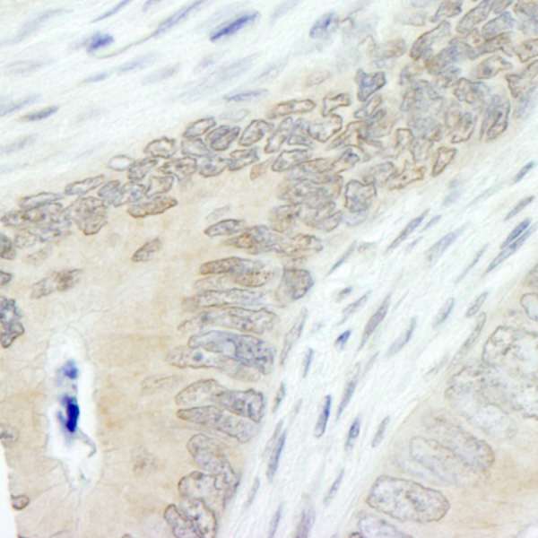 Detection of Human Lasu1/Ureb1 by Immunohistochemistry. Sample: FFPE section of human colon carcinoma. Antibody: Affinity purified rabbit anti-Lasu1/Ureb1 used at a dilution of 1:250.