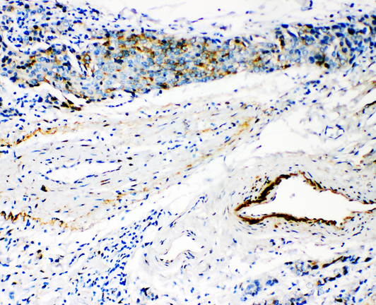 HYAL3 antibody. IHC(P): Human Breast Cancer Tissue.