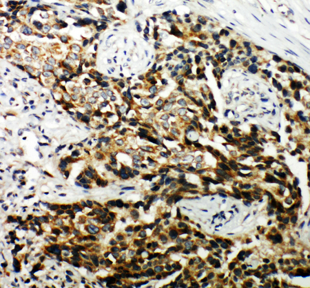 Hamartin / TSC1 antibody. IHC(P): Human Breast Cancer Tissue.