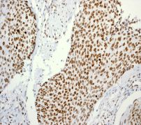 IHC of paraffin-embedded human cervical carcinoma using anti-Histone H3.3 antibody (LS-C105605).