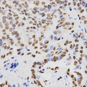Immunohistochemistry of paraffin-embedded human thyroid cancer tissue using H4K20me2 antibody at dilution of 1:200 (x400 lens).