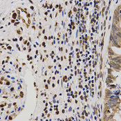 Immunohistochemistry of paraffin-embedded human rectal cancer tissue using H4R3me2a antibody at dilution of 1:200 (x400 lens).