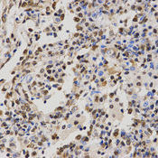 Immunohistochemistry of paraffin-embedded human lung cancer tissue using H4R3me2a antibody at dilution of 1:200 (x400 lens).