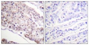 IHC of paraffin-embedded human breast carcinoma tissue, using Histone H4 (Acetyl-Lys8) Antibody. The picture on the right is treated with the synthesized peptide.