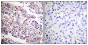 IHC of paraffin-embedded human breast carcinoma tissue, using Histone H4 (Acetyl-Lys12) Antibody. The picture on the right is treated with the synthesized peptide.