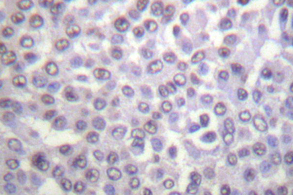 IHC of Histone H4 (K5) pAb in paraffin-embedded human breast carcinoma tissue.