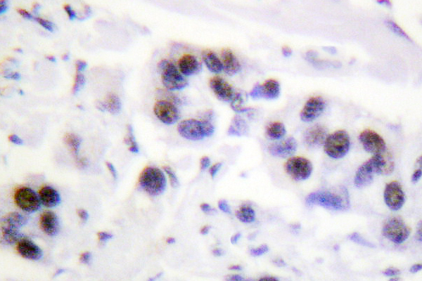 IHC of Histone H4 (S1) pAb in paraffin-embedded human breast carcinoma tissue.