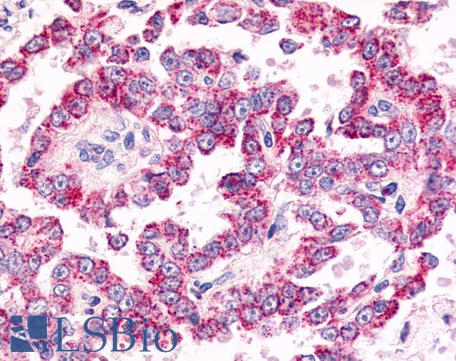 Anti-GPR26 antibody IHC of human Ovary, Carcinoma. Immunohistochemistry of formalin-fixed, paraffin-embedded tissue after heat-induced antigen retrieval.