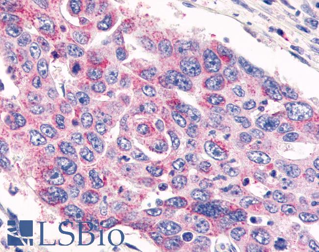 Anti-GPR26 antibody IHC of human Colon, Carcinoma. Immunohistochemistry of formalin-fixed, paraffin-embedded tissue after heat-induced antigen retrieval.