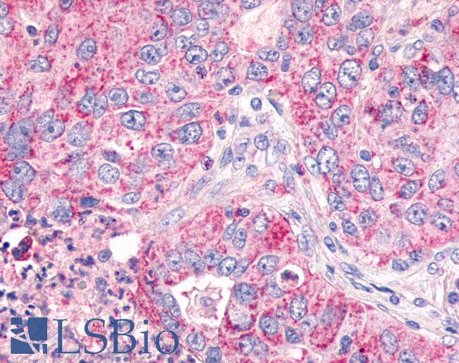 Anti-GPR26 antibody IHC of human Lung, Non-Small Cell Carcinoma. Immunohistochemistry of formalin-fixed, paraffin-embedded tissue after heat-induced antigen retrieval.