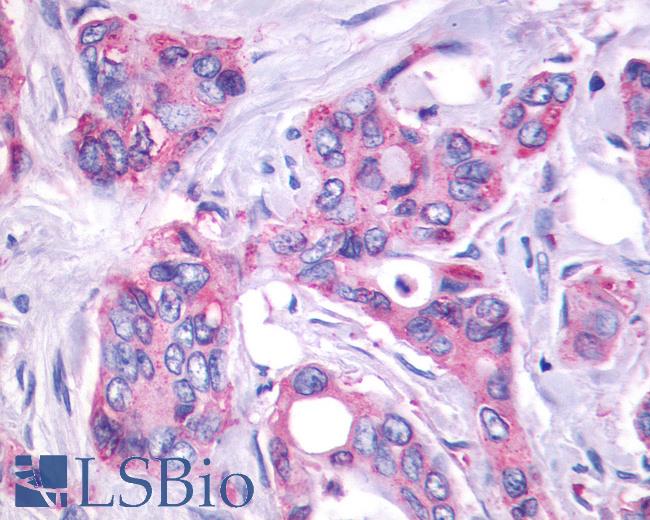 Anti-GPR27 antibody IHC of human Pancreas, Carcinoma. Immunohistochemistry of formalin-fixed, paraffin-embedded tissue after heat-induced antigen retrieval.