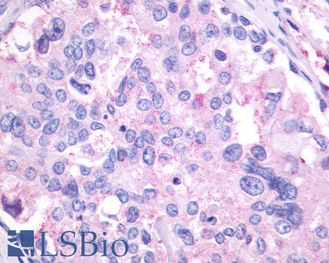 Anti-GPR27 antibody IHC of human Prostate, Carcinoma. Immunohistochemistry of formalin-fixed, paraffin-embedded tissue after heat-induced antigen retrieval.