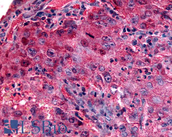 Anti-GPR27 antibody IHC of human Lung, Non-Small Cell Carcinoma. Immunohistochemistry of formalin-fixed, paraffin-embedded tissue after heat-induced antigen retrieval.