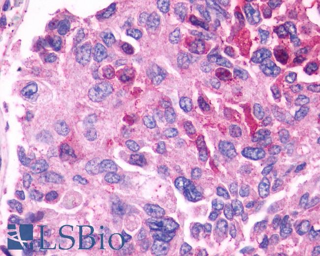 Anti-GPR27 antibody IHC of human prostate, carcinoma. Immunohistochemistry of formalin-fixed, paraffin-embedded tissue after heat-induced antigen retrieval.